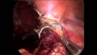 Laparoscopic Transabdominal Hernioplasty