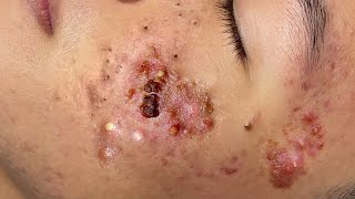 Big Cystic Acne Blackheads Extraction Blackheads \u0026 Milia, Whiteheads Removal Pimple Popping # 1696