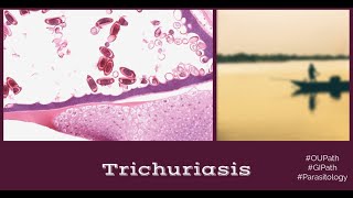 Trichuriasis