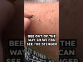 how to remove bee sting