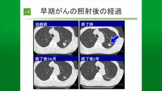 肺がんの放射線治療・陽子線治療