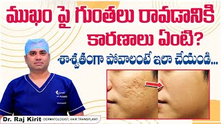 ముఖంపై గుంతలు పోవాలంటే | How to Remove Pimples Open Pores in Telugu | Celestee Skin And Hair Clinic