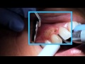 BIOLASE iLase Gingivoplasty