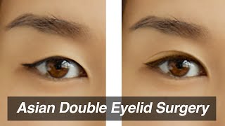 Asian Blepharoplasty (Monolid to Double Eyelid Surgery)