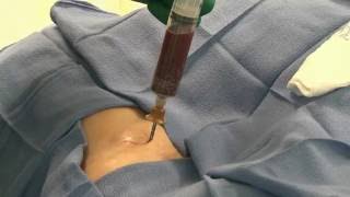 Bone Marrow Aspiration Cannula Ant Iliac Crest Instructions