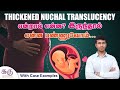 Thickened Nuchal Translucency என்றால் என்ன ? இருந்தால் என்ன பண்ணுவோம்  | Dr.KarthikSenthilvel