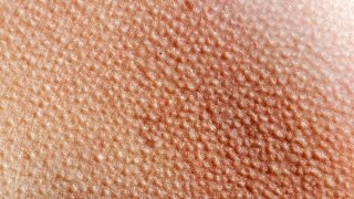 Why Do We Get Goosebumps?