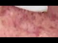 Blackheads And Whiteheads Extraction  Most Satisfying Video Face Skin Care with Calm Music #198