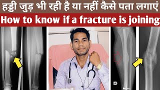 🦴 haddi judne ke sanket , haddi jodne ka ilaj, haddi jodne ke upay, haddi judne ki pahchan, fracture