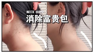 【SUB/ENG】Simple Fix on NECK HUMP | 快速消除富贵包 | 改善圆肩驼背，脖颈前伸 | 缓解肩颈酸痛  | 2周见效 | HEALTHY LIFESTYLE （2021）