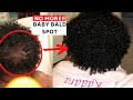 REGROW that baby bald spot FAST! Guaranteed Results every-time!