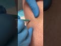 derm performs skin cancer testing skincancer mole dermreacts