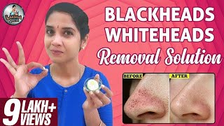 Blackheads Whiteheads | Homemade Removal Solution | Lakshya Junction