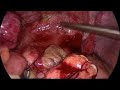 Rectal perforation:  laparoscopic repair