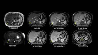 Pitfalls with Masses of the Liver