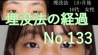 埋没法　133　10代女性　3か月目まで