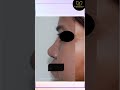 Rhinoplasty and Septoplasty | Result After 4 Months | Dr. Monisha Kapoor Aesthetics #nose #trending