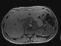 plexiform neurofibroma