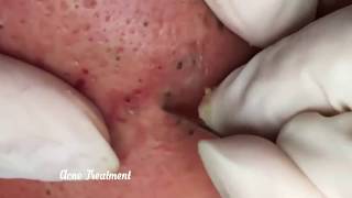 HUGE CLUSTERS OF BLACKHEADS