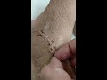 picking scabs after cast removal 1