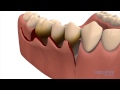 Periodontal flap approach surgery - Lapointe dental centres