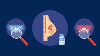 Lidocaine Injection Prior to Breast Cancer Surgery Reduces the Risk of Metastasis