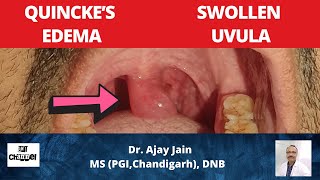 Swelling of uvula | Quincke Edema | Angioneurotic oedema | Uvula Functions | Causes | Management