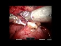 Evicel Partial Nephrectomy