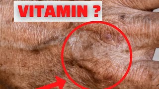 #1 VITAMIN FOR REMOVE OLD AGE SKIN SPOTS