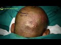 How to Get Natural & Best Results in Hair Transplantation? | Care Well Medical Centre