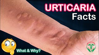 திடீர் வீக்கம் தானாக வருகிறதா? / ஏன் ? எப்படி ? / URTICARIA Facts / Clinical discussion / Dr.Selvin