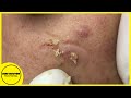 Suri Job 96: HIDDEN ACNE AND BLACKHEADS EXTRACTION