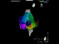 Ebstein's anomaly (atrial flutter) - Activation (propagation) map