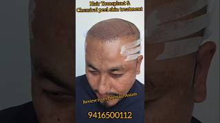 Hair transplant and chemical peel skin treatment. Review from Dhemaji, Assam.