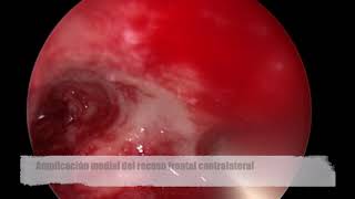 FRONTAL SINUS SURGERY. DRAFT IIB PROCEDURE.