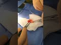 ablation des boules de bichat. bichectomie par dr. derder mohamed à travers une mini incision de 1cm