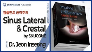 『임플란트 공리주의』 임상 동영상 - Sinus Lateral \u0026 Crestal by SNUCONE