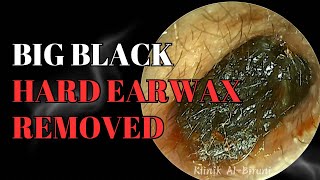 BIG BLACK Hard Earwax Removed