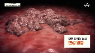 [교양] 100세 프로젝트 16회_210718_모든 질병의 불씨, 만성 염증