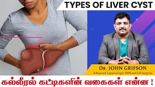 கல்லீரல் கட்டி காரணங்கள் அறிகுறிகள் சிகிச்சைகள்| Types of Liver Cyst in Tamil | John Gastro Hospital