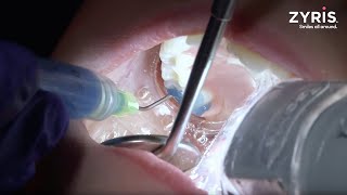 Zyris Isolite Sealant Procedure Dr Misti Pratt