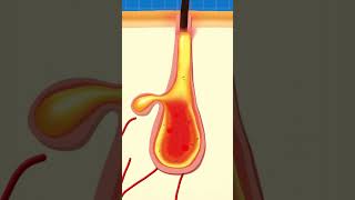 What's Inside A Pimple?