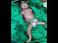 Cyclopia with proboscis: A rare congenital anomaly