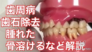 １７）歯周病　歯クリーニング　歯石　歯茎歯肉腫れた　膿　噛めない治療方法　説明動画１７　大宮　鈴木歯科医院