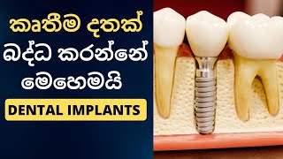 Dental Implants in Sinhala | ස්ථිර දතක් හිටවන විදිය | දත් බද්ද කිරීම 2024