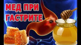 ★Мед при ГАСТРИТЕ. Эти рецепты приведут в норму уровень кислотности желудочного сока.