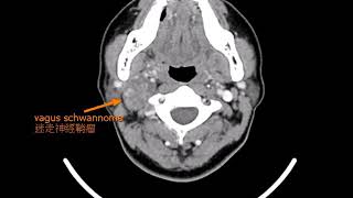 頸部迷走神經瘤(神經鞘瘤)手術 vagus nerve  schwannoma neurogenic tumor 劉耿僚醫師