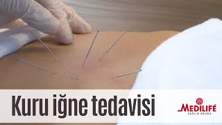 Kuru İğne tedavisi nasıl yapılır?