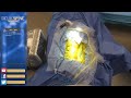 LIVE Spine Surgery: Three Level Lumbar DLDR (Minimally-Invasive Surgery)