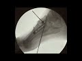 foot u0026 ankle international nitinol staple in primary arthrodesis of lisfranc fracture dislocations